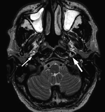 Pasient 5  Postganglion&aelig;r lesjon (carotisdisseksjon). En tidligere frisk mann i 50-&aring;rene v&aring;knet med venstresidig hodepine&hellip;