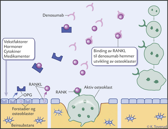 Figur 1  Denosumab &ndash; virkningsmekanisme. OPG er osteoprotegerin, RANK er reseptoraktivator av nukle&aelig;r faktor kappaB og RANKL&hellip;