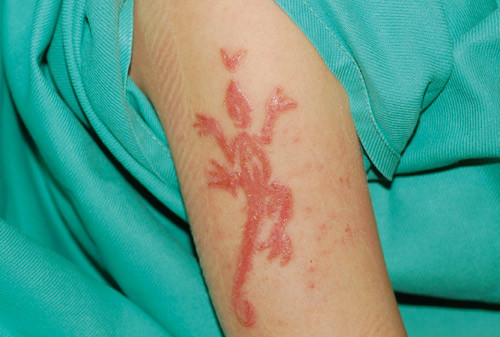 Figur 1  Reaksjon etter hennatatovering