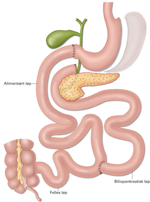 Figur 1  Biliopankreatisk avledning med duodenal omkobling. &copy; Kari Toverud
