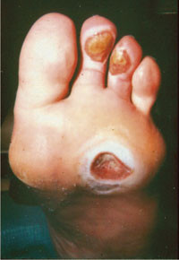 Diabetisk fots&aring;r. Foto Eivind Wits&oslash;