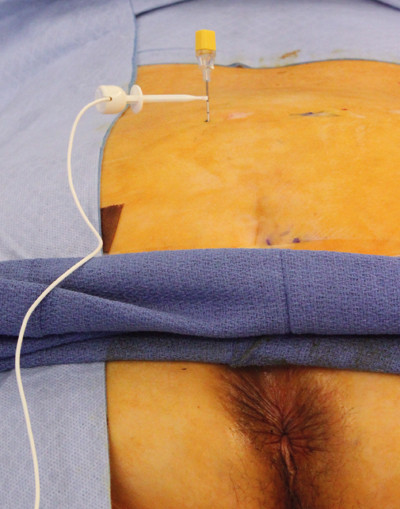 Figur 3  Kanyle p&aring; plass i tredje sakralforamen p&aring; venstre side. Kanylen er tilkoblet str&oslash;mkabel for testing av motorisk&hellip;