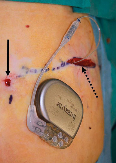 Figur 4  Permanent stimulator tilkoblet elektrode som er tunnellert subkutant fra tredje sakralforamen p&aring; h&oslash;yre side (pil)&hellip;