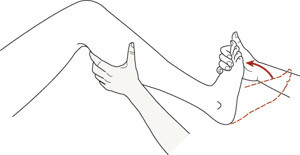 Figur 1  Homans tegn. Dersom det oppst&aring;r smerte i tykkleggen ved dorsalfleksjon i fotleddet, kan det v&aelig;re et tegn p&aring; dyp&hellip;