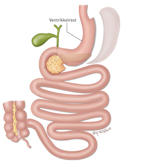 Figur 3  Langsg&aring;ende ventrikkelreseksjon (sleeve-gastrektomi). Magesekkens volum reduseres kraftig med en vertikal reseksjon&hellip;