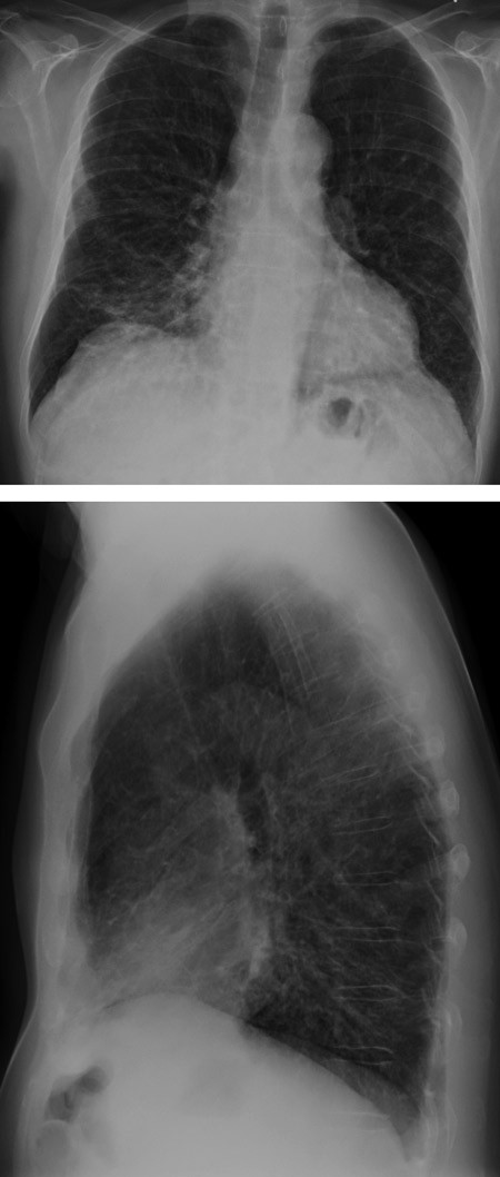 Figur 1  R&oslash;ntgen thorax viser interstitielle fibr&oslash;st pregede fortetninger spredt i begge lunger, hovedsakelig perihil&aelig;rt i&hellip;