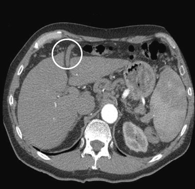 Figur 2  CT-abdomen i tidlig arteriell fase viser &aring;pentst&aring;ende umbilikalvene som ga mistanke om portal hypertensjon