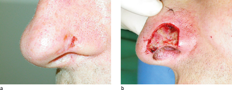 Figur 1  a) Morfealiknende basalcellekarsinom p&aring; nesevingen f&oslash;r operasjon. b) Samme lesjon etter tre eksisjoner med Mohs&rsquo;&hellip;