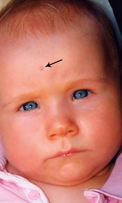 Figur 2  Stikket som er antatt &aring; v&aelig;re inngangsporten for infeksjonen. Gjengitt med tillatelse fra pasientens foreldre. Foto&hellip;