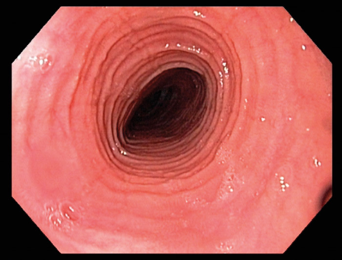 Figur 1  Typiske langsg&aring;ende furer i spiser&oslash;ret. 9,8 mm skop kunne ikke passere initialt. Bildene er gjengitt med tillatelse&hellip;
