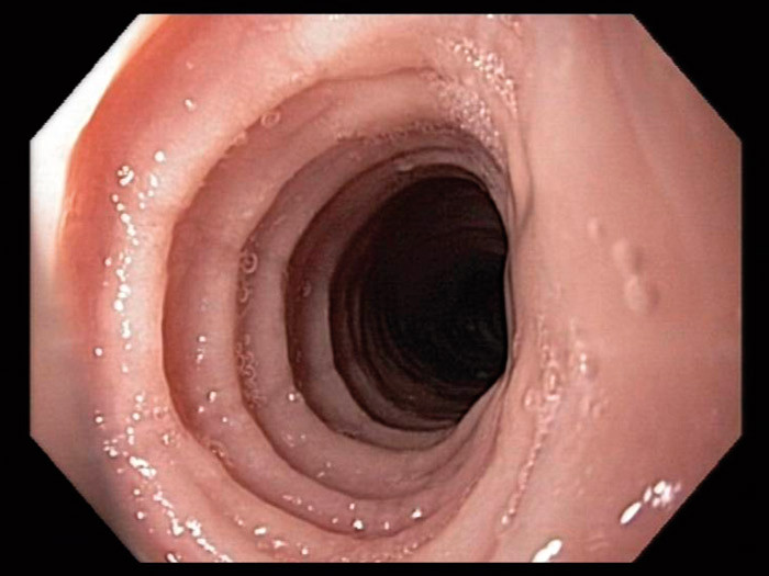 Figur 2  Konsentriske ringer i spiser&oslash;ret ved endoskopi
