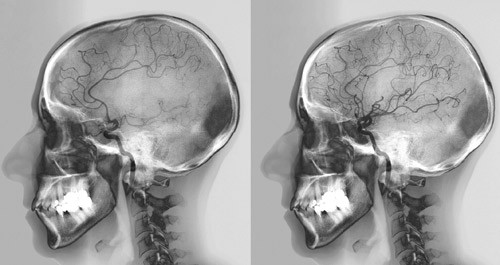Intrakranial sirkulasjon f&oslash;r og etter revaskularisering. Illustrasjonsfoto Sciencephoto/SCANPIX