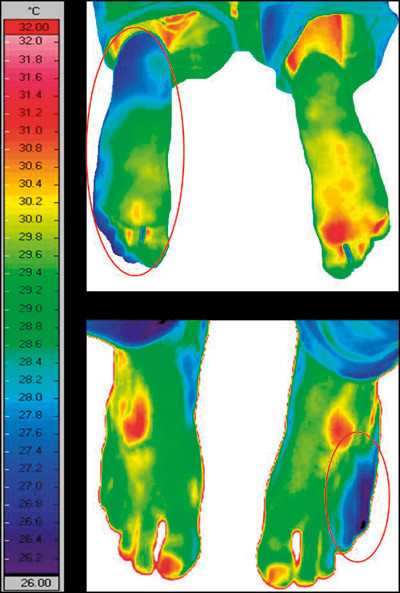 Figur 1  Infrar&oslash;dt termogram fra en pasient der det var klinisk mistanke om kuldeskade (non-freezing cold injury, NFCI)&hellip;