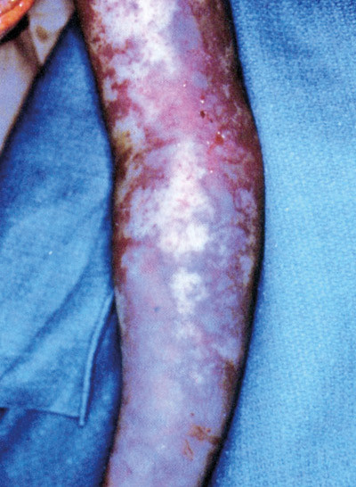 Moderne tilfelle av flekktyfus, hvor armen er bl&aring;svart som f&oslash;lge av hemoragier. Fra Rubin''s pathology: clinicopathologic&hellip;