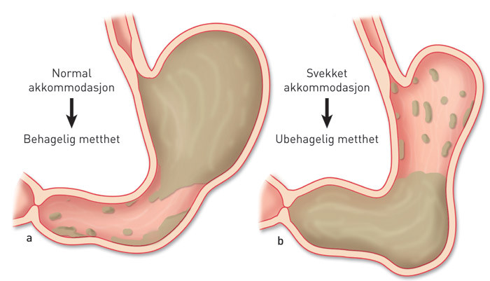 Figur 1  Magesekkens akkommodasjon og dens betydning for metthet. a) Ved normal akkommodasjon relakseres den &oslash;verste delen&hellip;