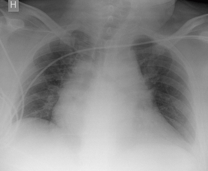 Figur 1  R&oslash;ntgen thorax tatt ved innkomst viser funn forenlig med bredde&oslash;kt mediastinum. Det er klare lunger, ingen&hellip;