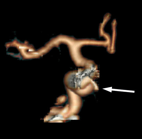 Figur 2  CT-angiografi tatt ved innkomst. Pseudoaneurisme p&aring; a. carotis interna (pil)