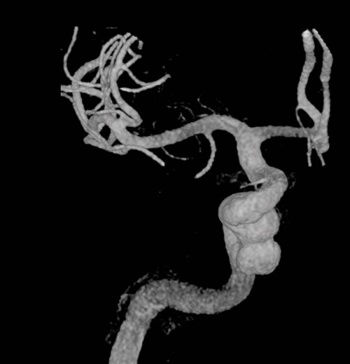 Figur 5  Angiografi tatt preoperativt for &aring; kartlegge aneurismet og blodtilf&oslash;rselen til hjernen. Denne viste et stort&hellip;
