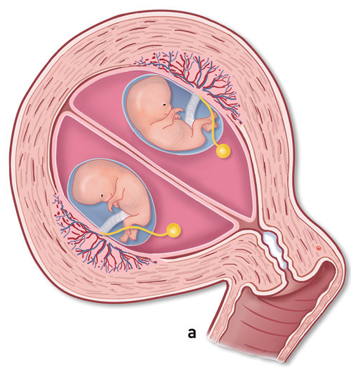Figur 1  a) To separate placentaer/to fostersekker.