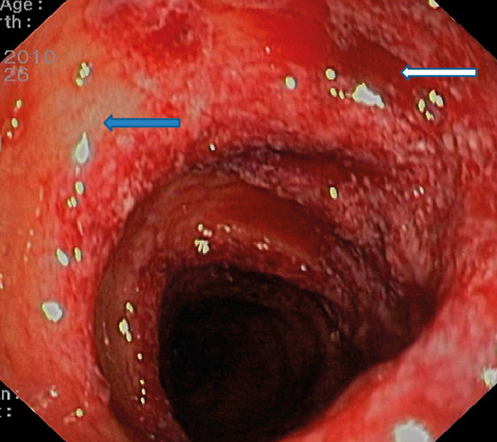 Figur 1  Endoskopisk bilde av iskemisk kolitt. Submukosale bl&oslash;dninger (hvit pil) med &oslash;dem i slimhinnen og utvisket&hellip;