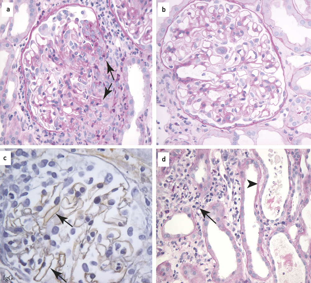 Figur 1  Nyrebiopsi fra pasienten. a) Halvm&aring;ne (piler), b) Normal glomerulus, c) Line&aelig;rt nedslag av IgG (pil), d) Dilatert&hellip;