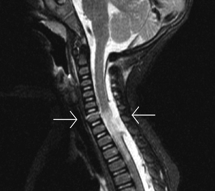 Figur 1  Sagittalsnitt. T2-vektet MR-bilde. Pilene viser skade av ryggmarg fra C6 til Th4, fraktur i C6 og duraruptur