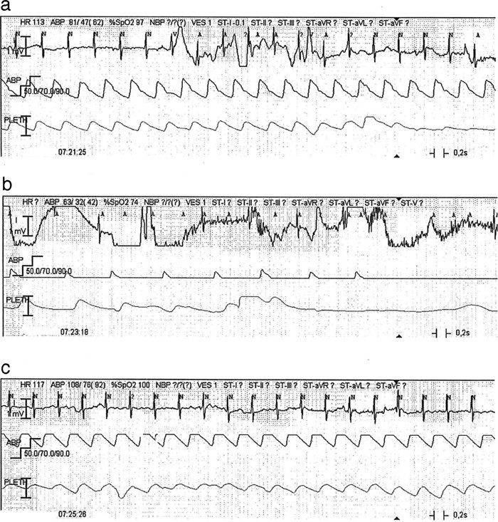 Figur 2  Utskrift av overv&aring;king med EKG (&oslash;verst), intraarterielt blodtrykk (midten) og oksygenmetning (nederst) a) f&oslash;r&hellip;