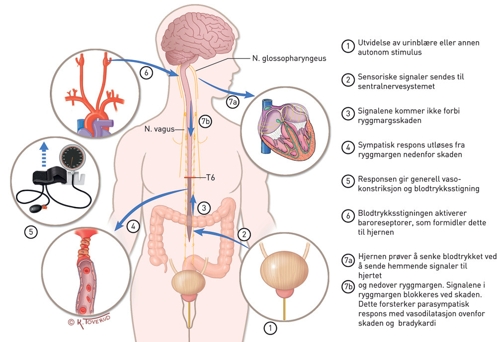 Figur 3  Skjematisk fremstilling av autonom dysrefleksi. Figuren er basert p&aring; en illustrasjon fra Canadian Medical Journal,&hellip;