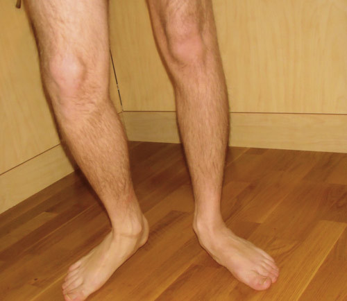 Feilstillinger i beina med pronasjon i ankler og fleksjon i kn&aelig;r (crouch gait). Foto Eylert Brodtkorb