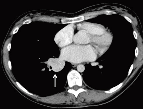 Figur 1  CT thorax viser perihil&aelig;r fortetning i h&oslash;yre lunge (pil)