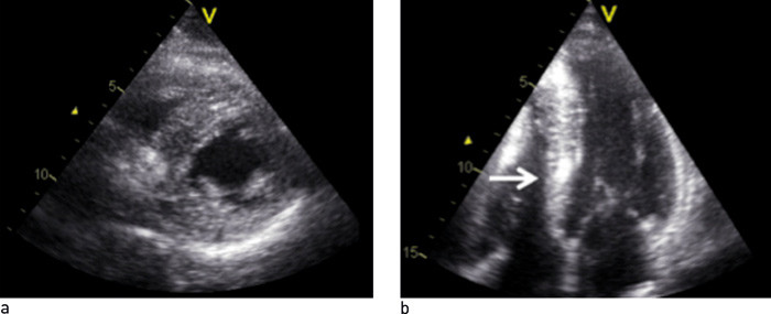 Figur 2  Ekkokardiografisk unders&oslash;kelse. a) Parasternalt kortaksebilde og b) apikalt firekammerbilde i diastolen. Bildene&hellip;