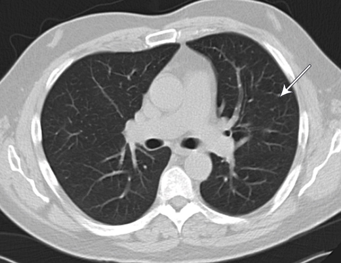 Figur 4  CT thorax. Sm&aring; uspesifikke nodul&aelig;re fortetninger i venstre overlapp