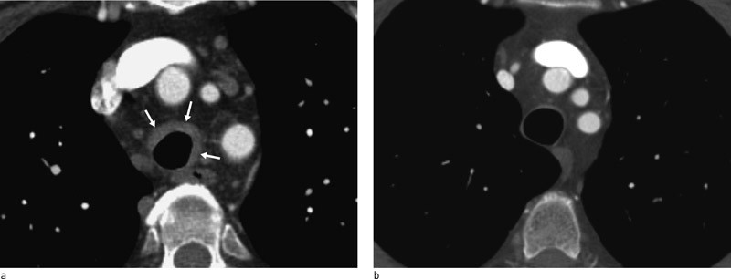 Figur 1  a) CT-snitt gjennom mediastinum litt kranialt for aortabuen viser betydelig fortykket trakealvegg. b) Normal&hellip;