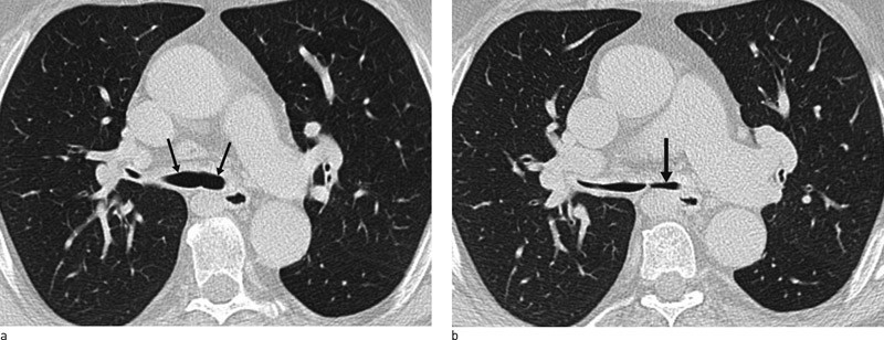 Figur 2  CT-snitt gjennom distale trachea og hovedbronkier i a) inspirasjon og b) ekspirasjon. I ekspirasjon fremkommer&hellip;
