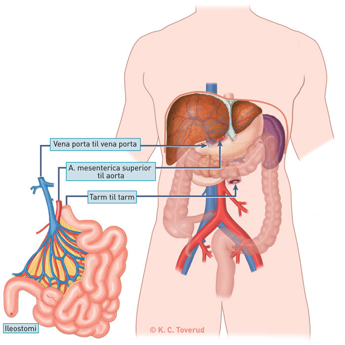 Figur 1  Isolert tarmtransplantasjon med arterie- og portaanastomose i tillegg til tarmanastomose og ileostomi