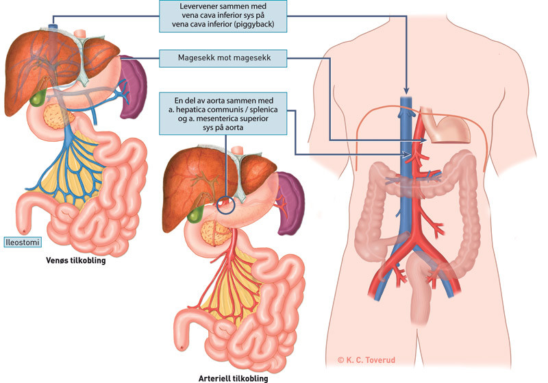 Figur 2  Flerorgantransplantasjon (multivisceral transplantasjon) som omfatter tynntarm, ventrikkel, duodenum, pancreas og&hellip;