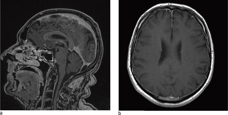 Figur 2  Cerebral MR &ndash; a) fra siden, b) nedenfra &ndash; viser oppladning av gadolinium i pachymeninges hos en mann med postural&hellip;