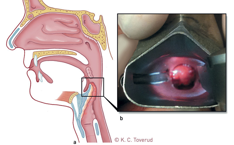 a) Sagittalt snitt gjennom hode og hals med hevelse i epiglottis. b) Fotografi av hevelsen i epiglottis (fra &oslash;re-nese-hals&hellip;