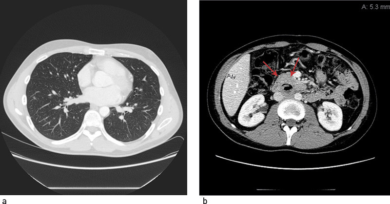 Figur 2  a) CT thorax ved siste kontroll. Tiln&aelig;rmet full tilbakegang av lungeforandringer. b) CT abdomen som viser&hellip;