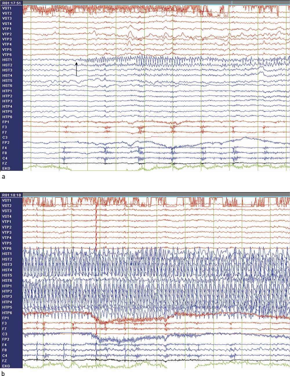 Figur 2  a) EEG fra pasient med temporallappsanfall og h&oslash;yresidig hippocampussklerose. Det er registrert fra b&aring;de&hellip;