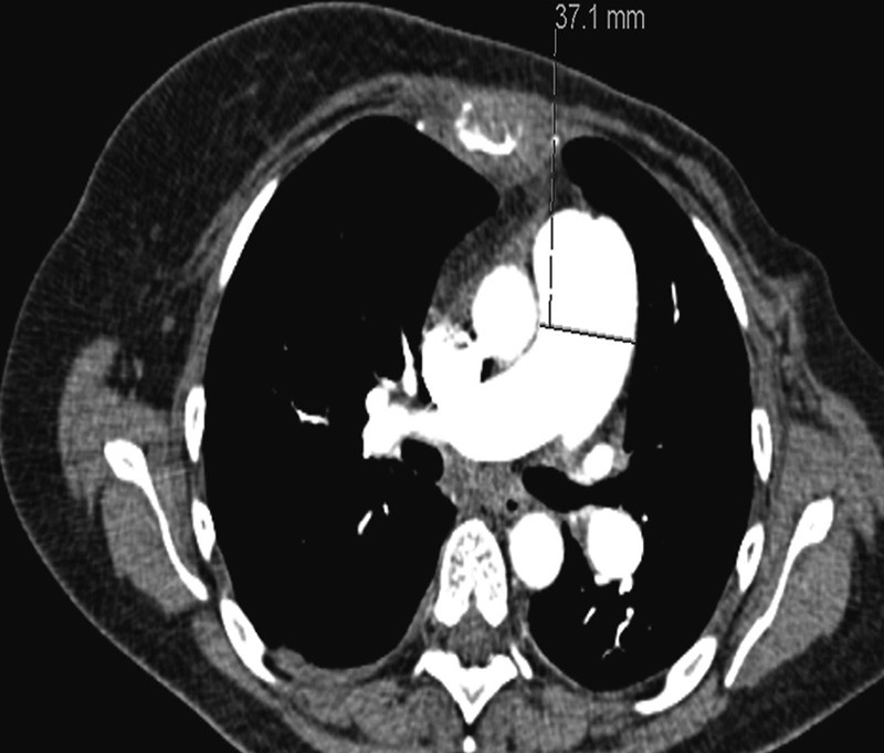 Figur 2  Volum CT thorax med intraven&oslash;s kontrast tatt under siste innleggelse viser markert truncus pulmonalis med diameter&hellip;
