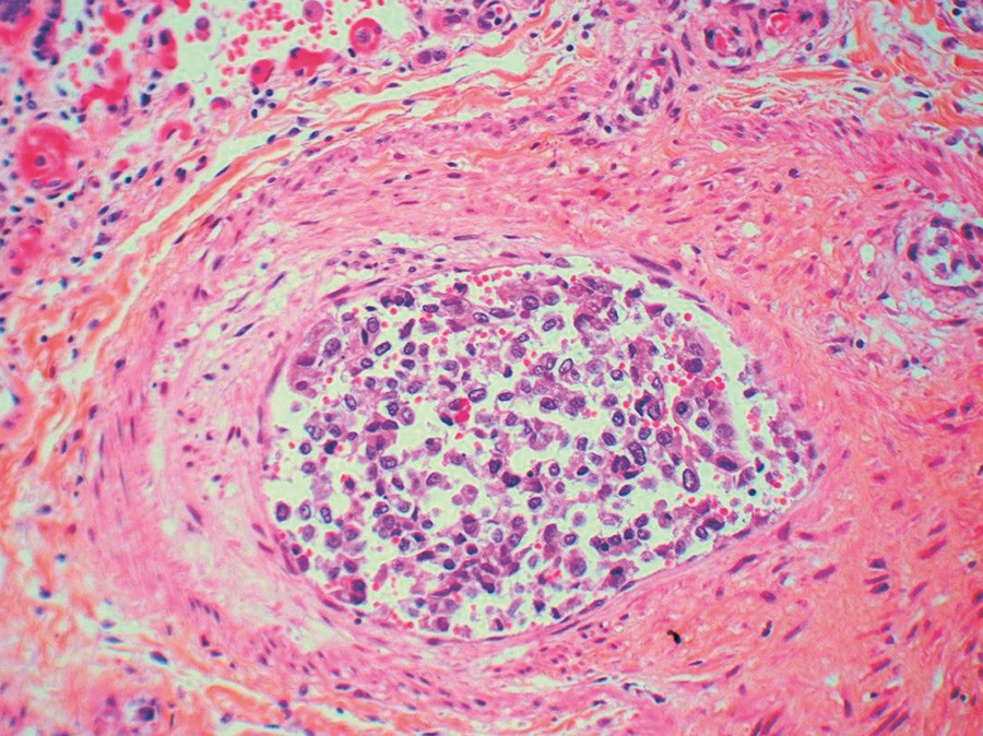 Figur 3  Liten lungearterie med tumorceller i karlumen (hematoksylin-erytrosin-safran (HES))