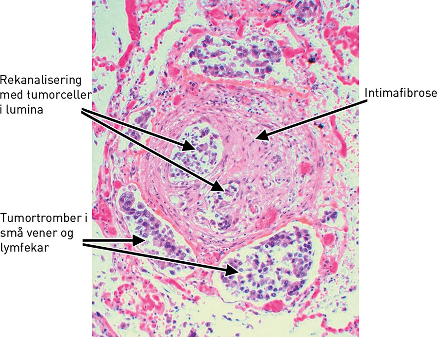 Figur 4  Arterie med intimafibrose, rekanalisering og tumortromber b&aring;de i arterie og i ledsagende vener/lymfekar (HES)