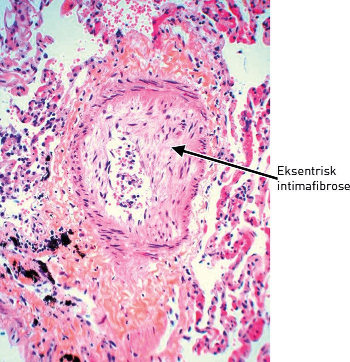 Figur 5  Liten lungearterie med eksentrisk fibrose av intima (HES)