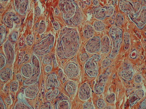 Figur 1  Multiple prolifererende nervefasikler med omkringliggende kompakt kollagen