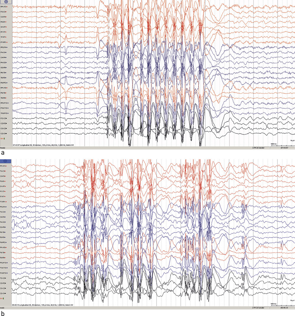 Figur 1  EEG fra en ung gutt med juvenil myoklonusepilepsi. Kurvene viser utbrudd av 3 Hz generaliserte polyspike-waves a) i&hellip;