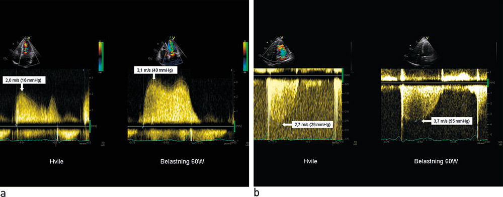 Figur 3  Ung pasient med dyspn&eacute; ved anstrengelse. Doppleregistreninger fra a) mitralkaffen og fra b) trikuspidalklaffen i&hellip;