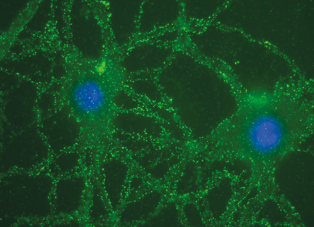 Figure 2  Two neurons in a cell culture from a rat hippocampus, immunostained with cerebrospinal fluid from a patient. The&hellip;