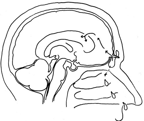 Fig 4  Patogenesen for hydrocephalus. Fullt opptrukne piler: Luft som bl&aring;ser opp ventrikkelsystemet. Prikket pil:&hellip;