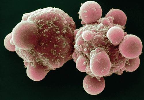 Skanningelektronmikroskopi av celler i apoptose (programmert celled&oslash;d). Foto Science Photo Library/NTB scanpix